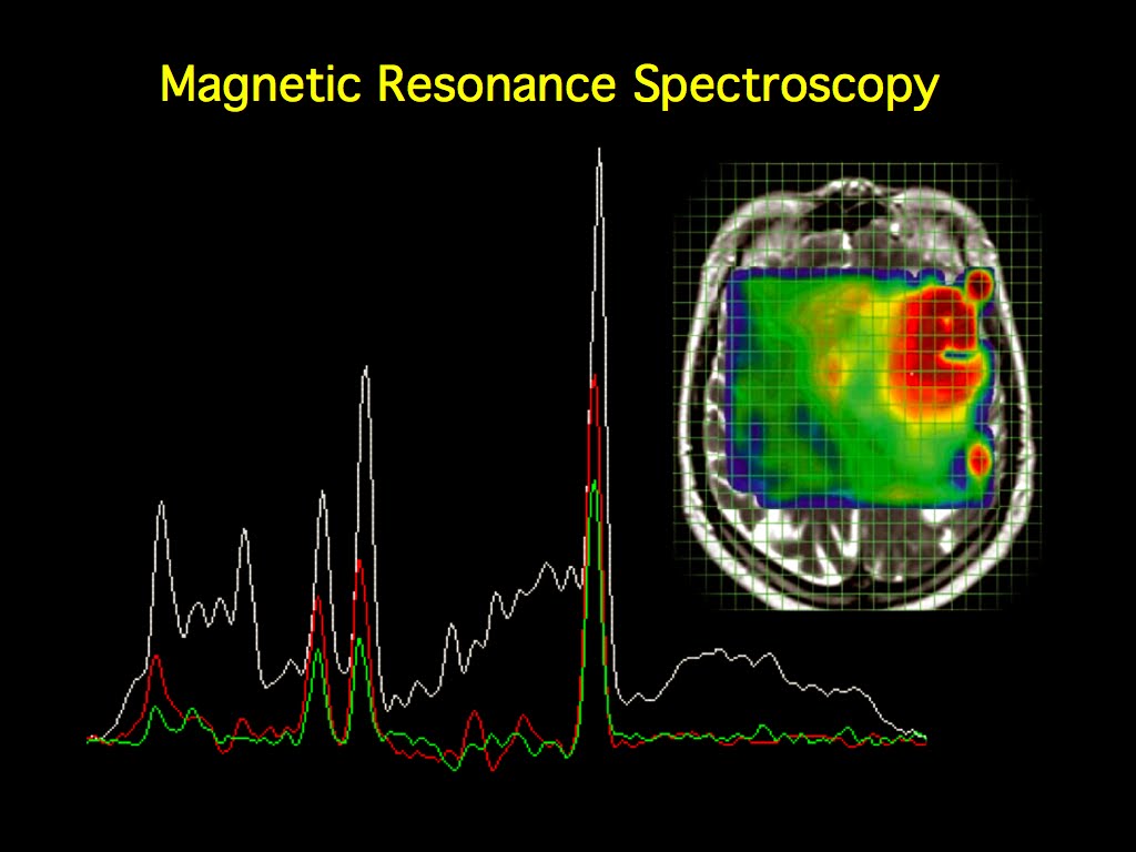 MRI BLOG: Magnetic Resonance Spectroscopy