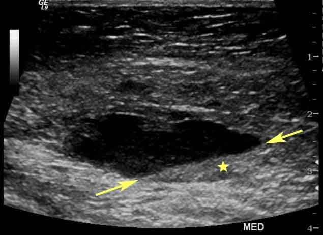 breast ultrasound